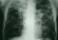 塵肺病將納入醫保特殊疾病管理？國家醫保局回復