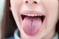 舌頭有裂紋怎麼辦？是這些原因導致的，教你兩味中藥調理