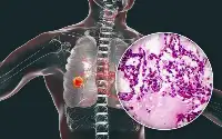 肺癌復發轉移前，身體會發出哪些訊號？