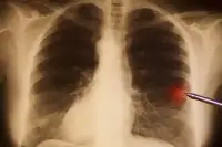體檢胸片沒看到什麼，一查CT卻發現肺癌，到底什麼情况？