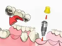 牙齒缺失後，陷入鑲牙or種牙之間難以抉擇？良心牙醫告訴你怎麼選